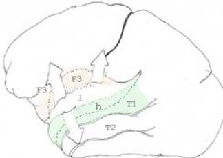 brain_heschl.jpg (11746 octets)