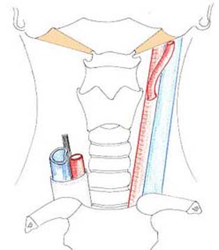carotid19.jpg (17293 octets)