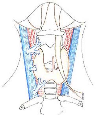 carotid23.JPG (21958 octets)