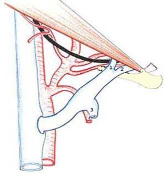 carotid26'.jpg (20131 octets)