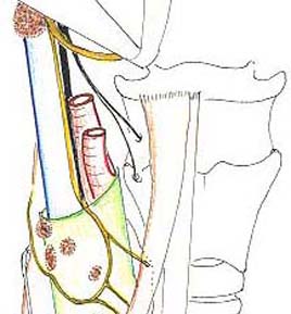 carotid34.jpg (21963 octets)