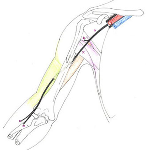 radial14.jpg (23055 octets)